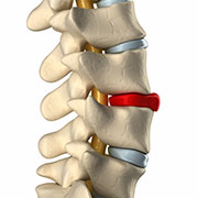 Bulding disc in spine