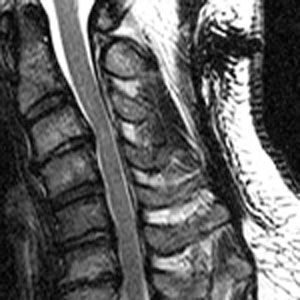 black and white photo of Cervical Spinal Stenosis
