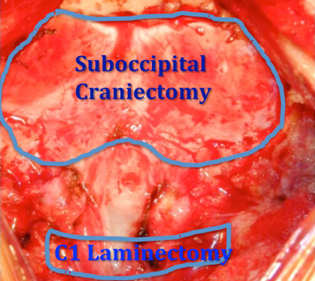 Suboccipital Craniectomy