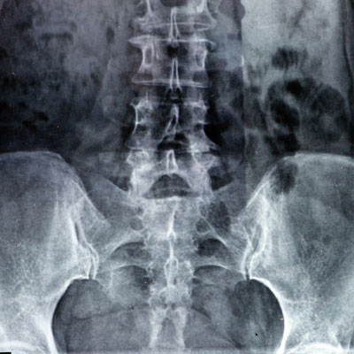 x-ray result